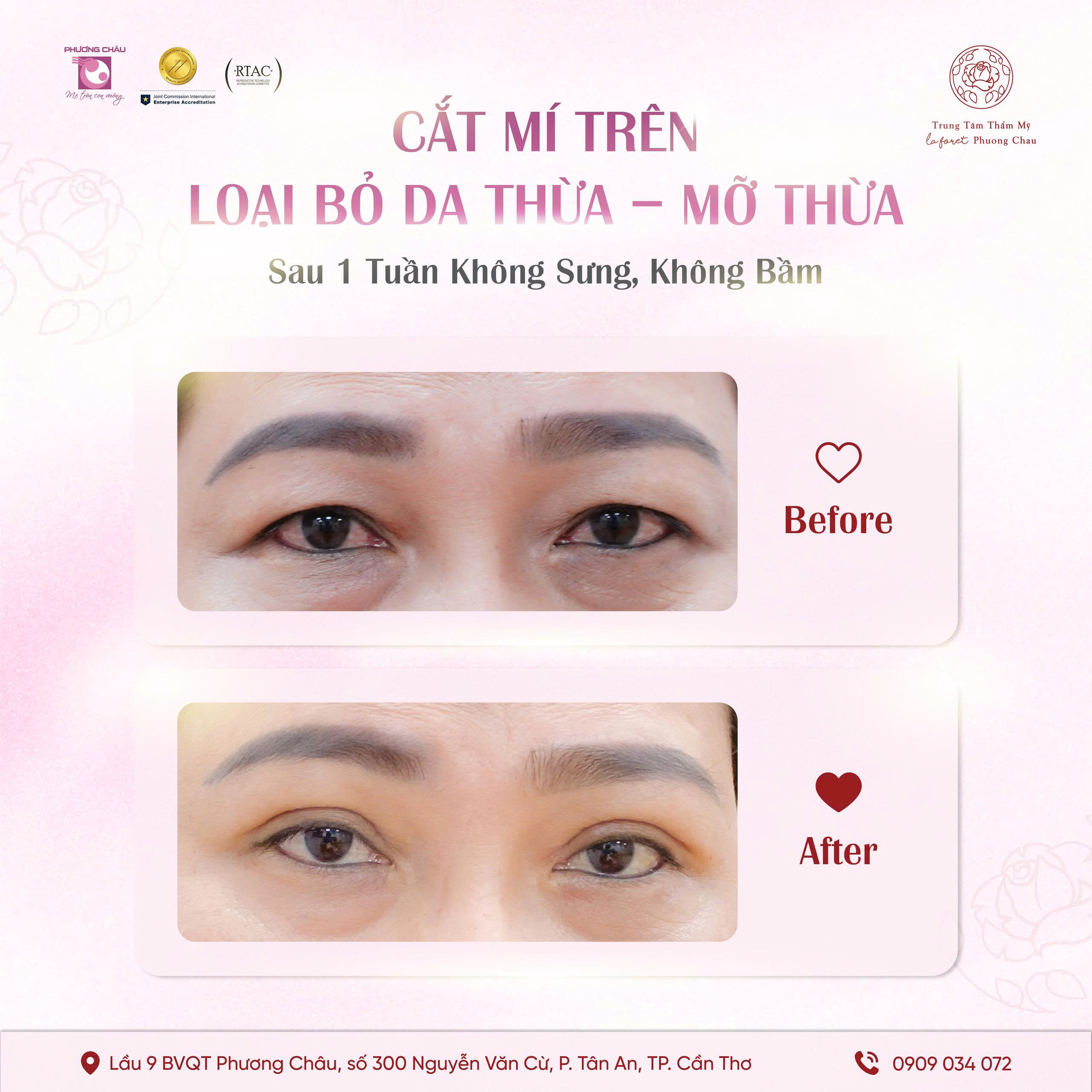 Cắt Mí Trên, Loại Bỏ Da Thừa – Mỡ Thừa Cùng La Foret