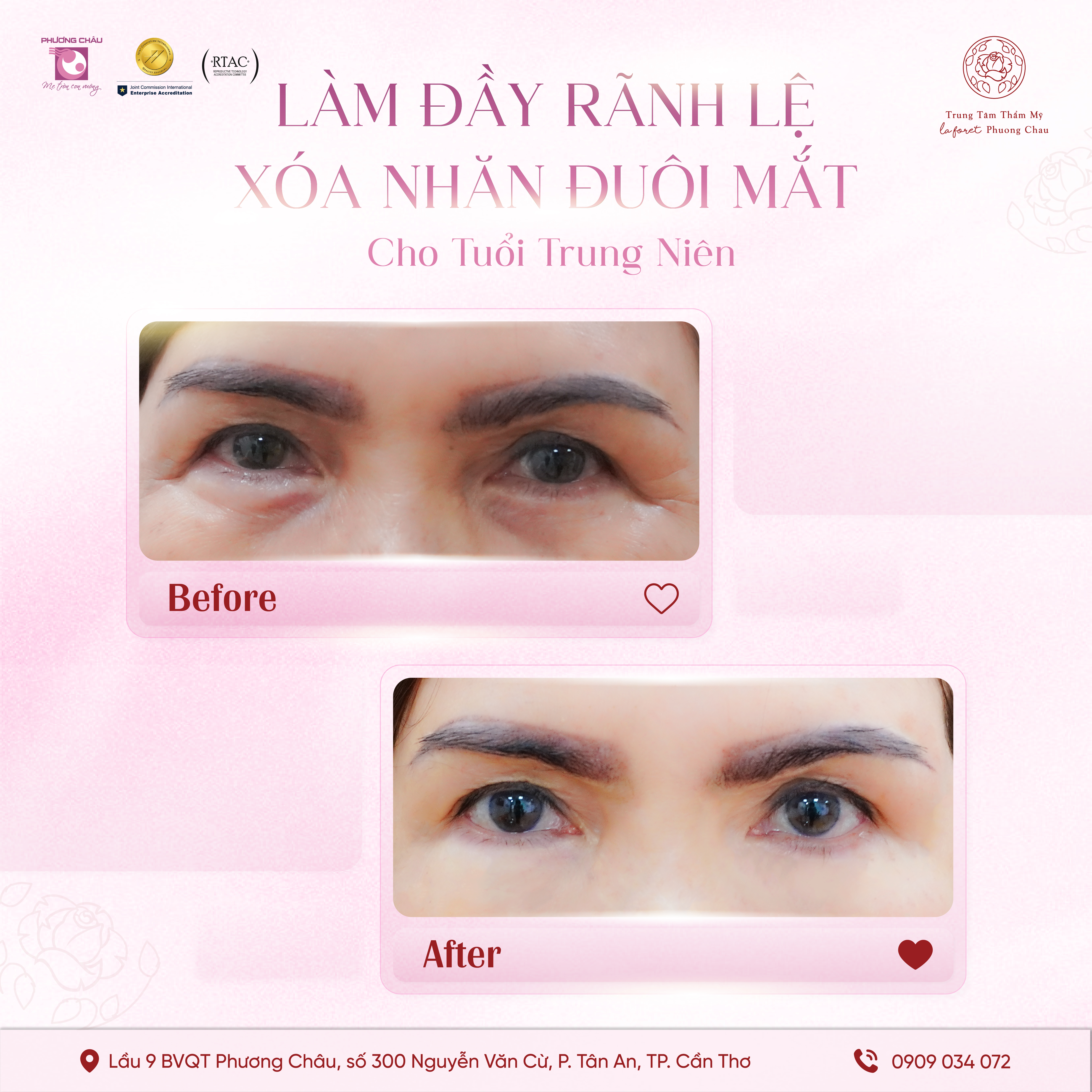 Làm Đầy Rãnh Lệ, Xóa Nhăn Đuôi Mắt – Giải Pháp Trẻ Hóa Nhẹ Nhàng Cho Tuổi Trung Niên