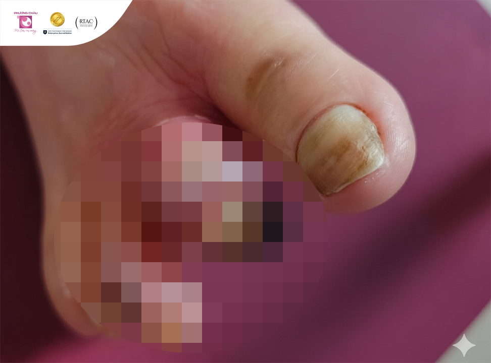 Đái tháo đường: Mối nguy hiểm tiềm ẩn từ diễn tiến âm thầm và khó kiểm soát