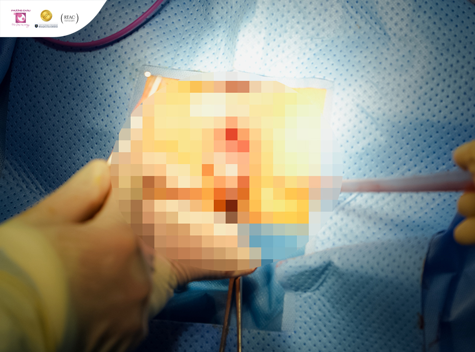 Phẫu thuật điều trị trĩ hỗn hợp tắc mạch tại Phương Châu