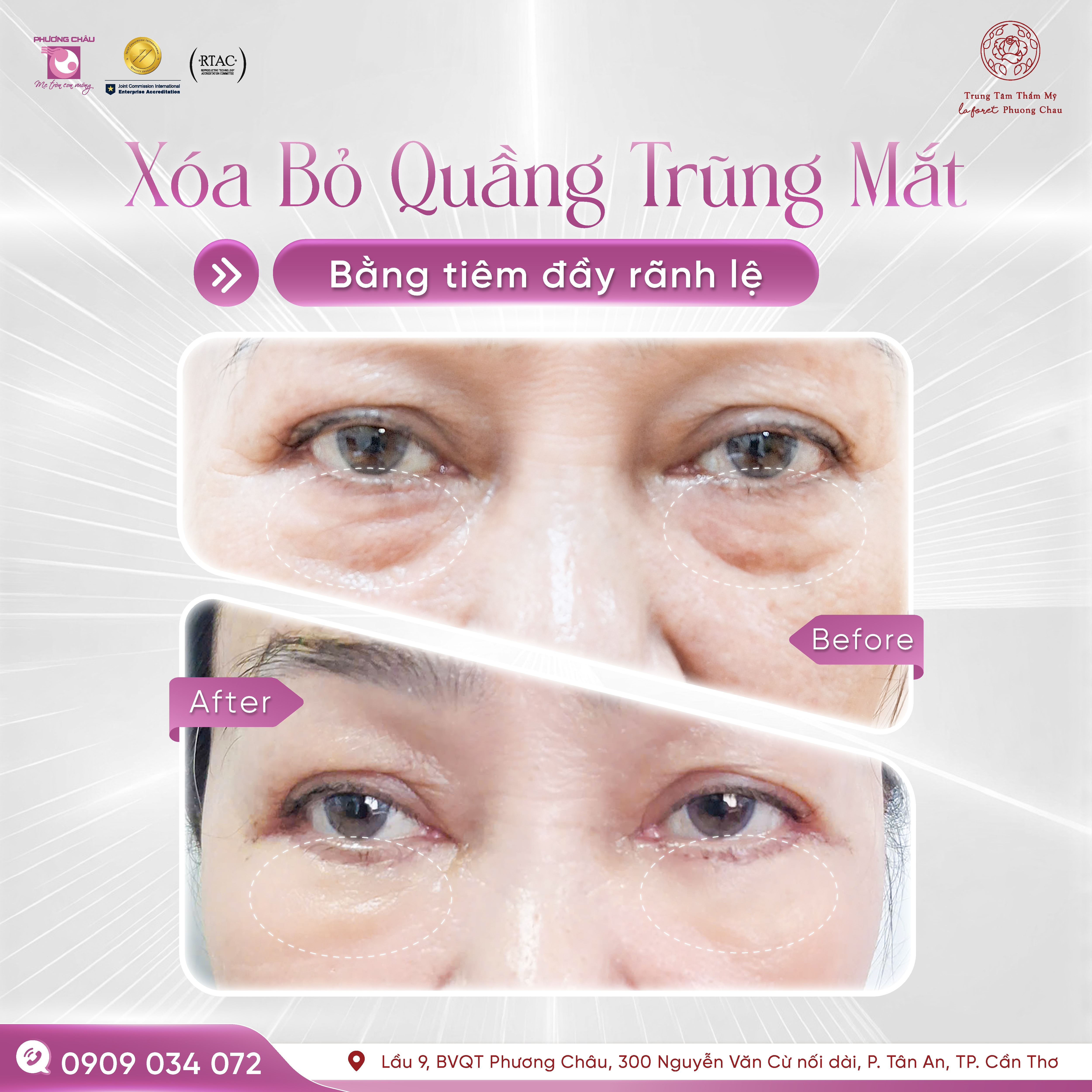 Xóa Quầng Trũng Dưới Mắt Bằng Tiêm Đầy Rãnh Lệ