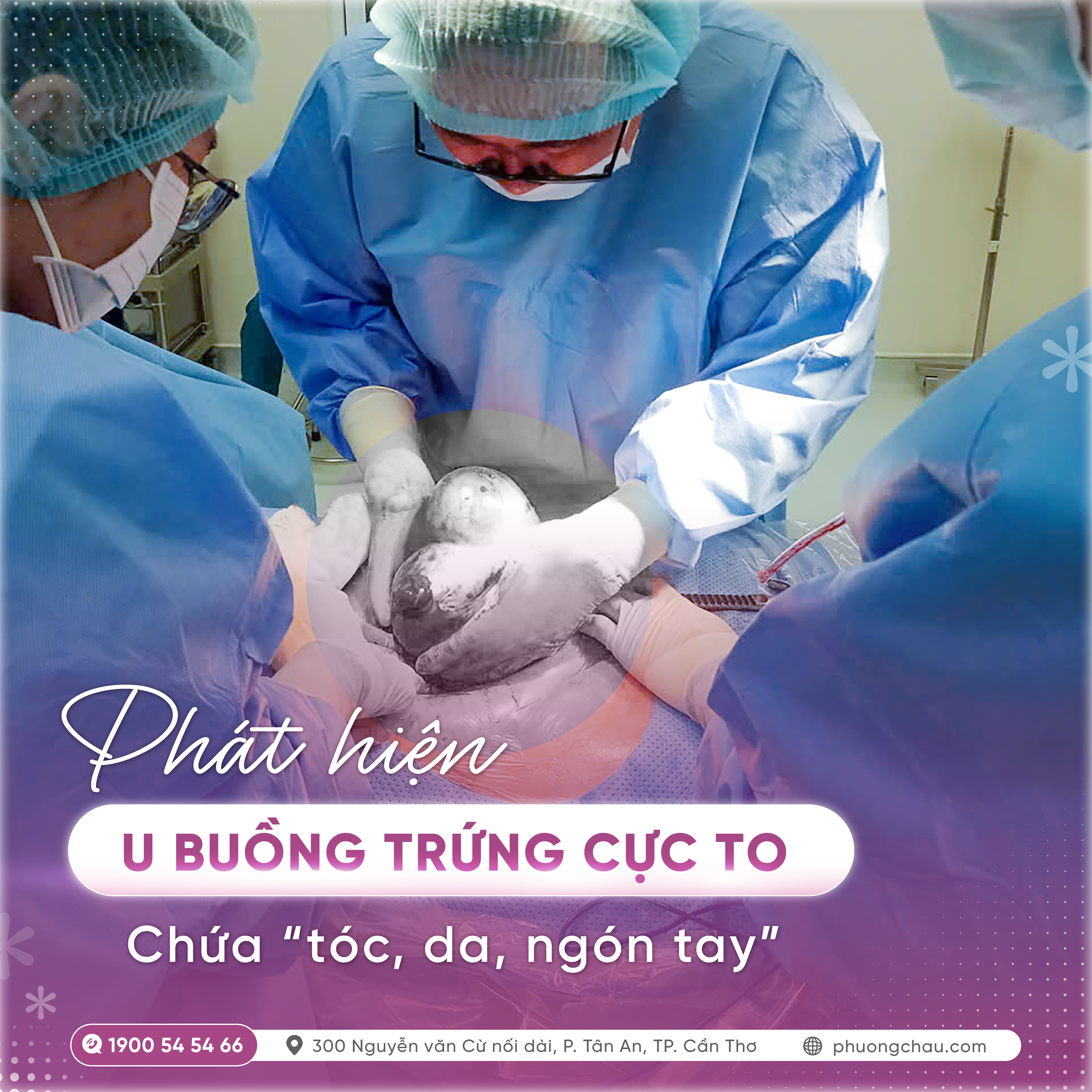 U buồng trứng cực to 20cm chứa tóc, da và mô dạng ngón tay