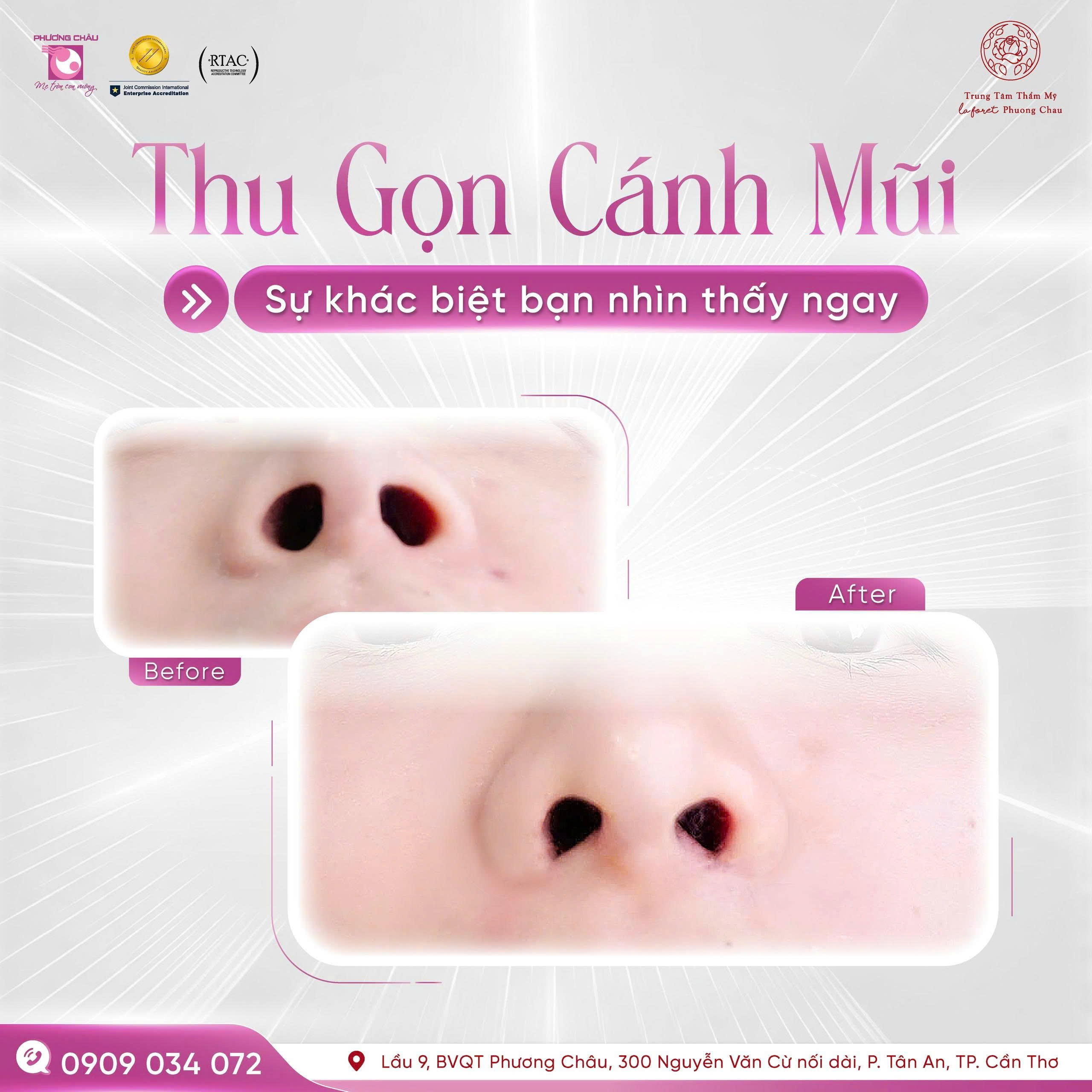 Thu Gọn Cánh Mũi – Giải Pháp Tinh Tế Cho Dáng Mũi Thanh Thoát
