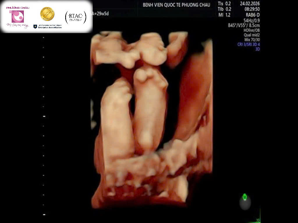 Phát hiện thai nhi 29 tuần tuổi mắc phải hội chứng nghiêm trọng (tỷ lệ 1/500.000 trẻ)