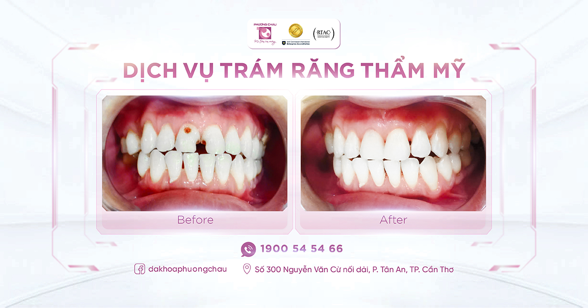 Trám răng thẩm mỹ: Phương pháp phục hồi răng sâu nhẹ nhanh chóng và thẩm mỹ