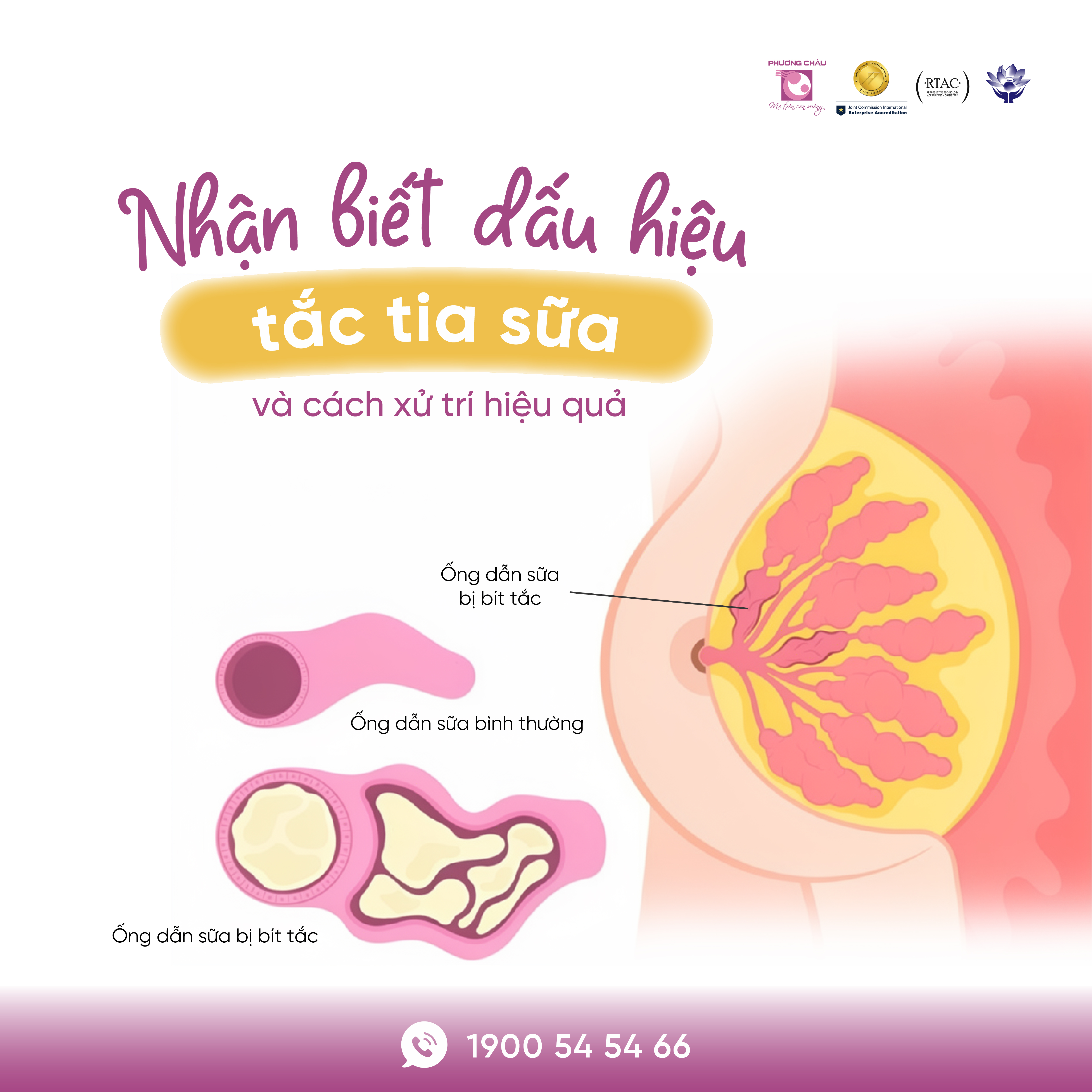 Tắc tia sữa sau sinh - Nhận diện và cách xử trí