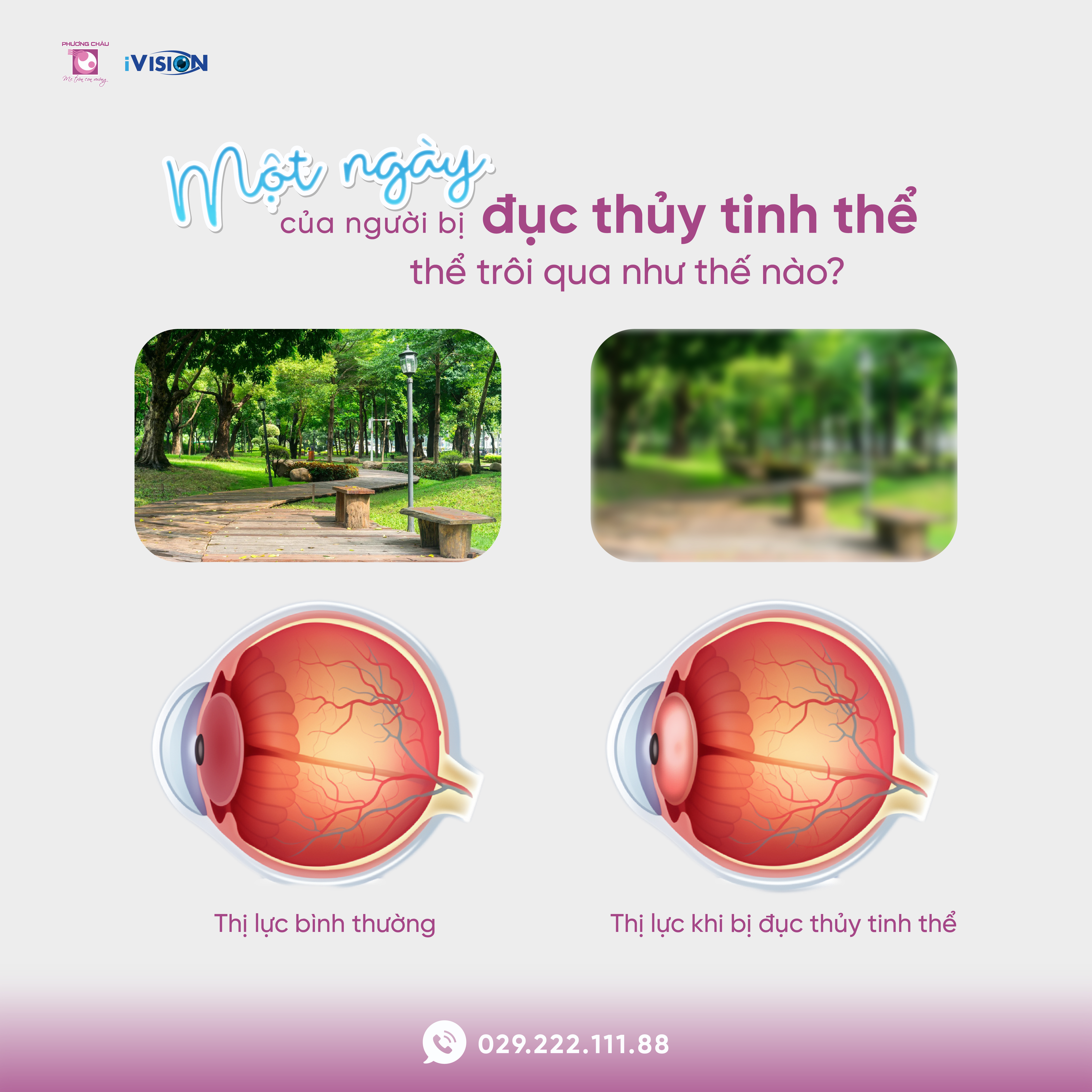 Một Ngày Của Người Bị Đục Thủy Tinh Thể Diễn Ra Như Thế Nào?