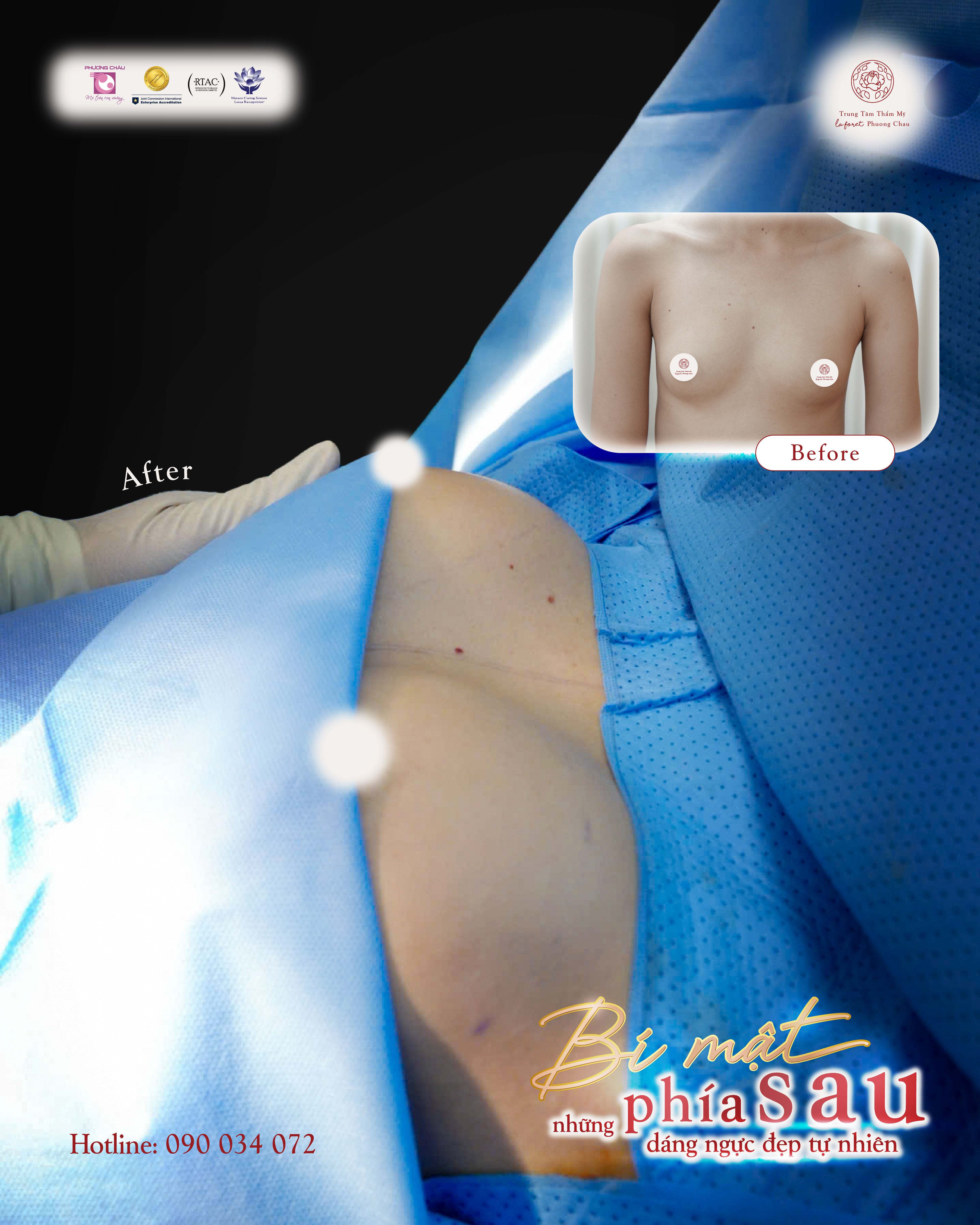 Nâng ngực nội soi – Giải pháp tối ưu cho dáng ngực tự nhiên, cân đối