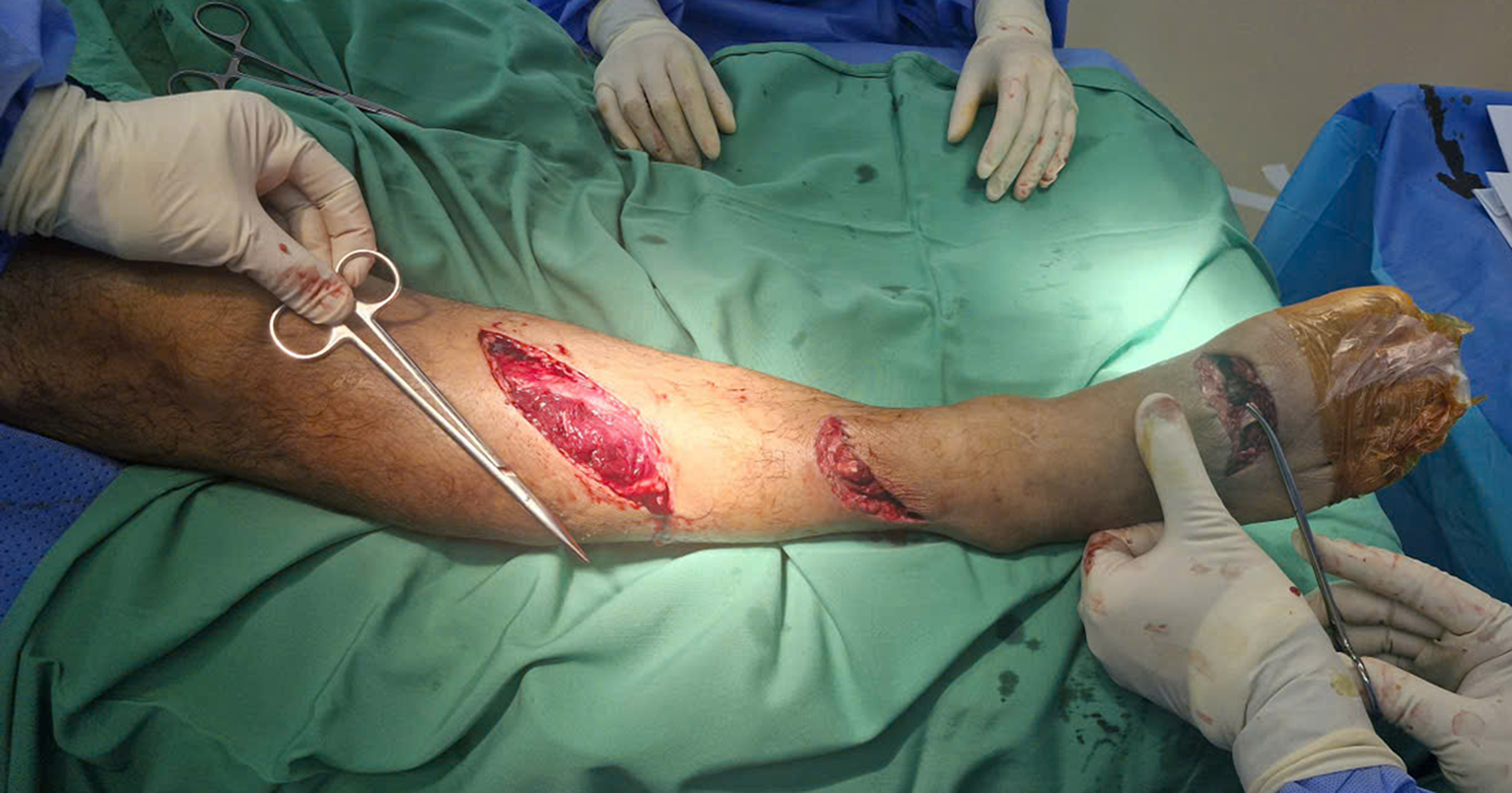 Bảo tồn được bàn chân trong tai nạn máy cưa nghiêm trọng nhờ cấp cứu đúng thời gian vàng và quy trình an toàn theo chuẩn JCI