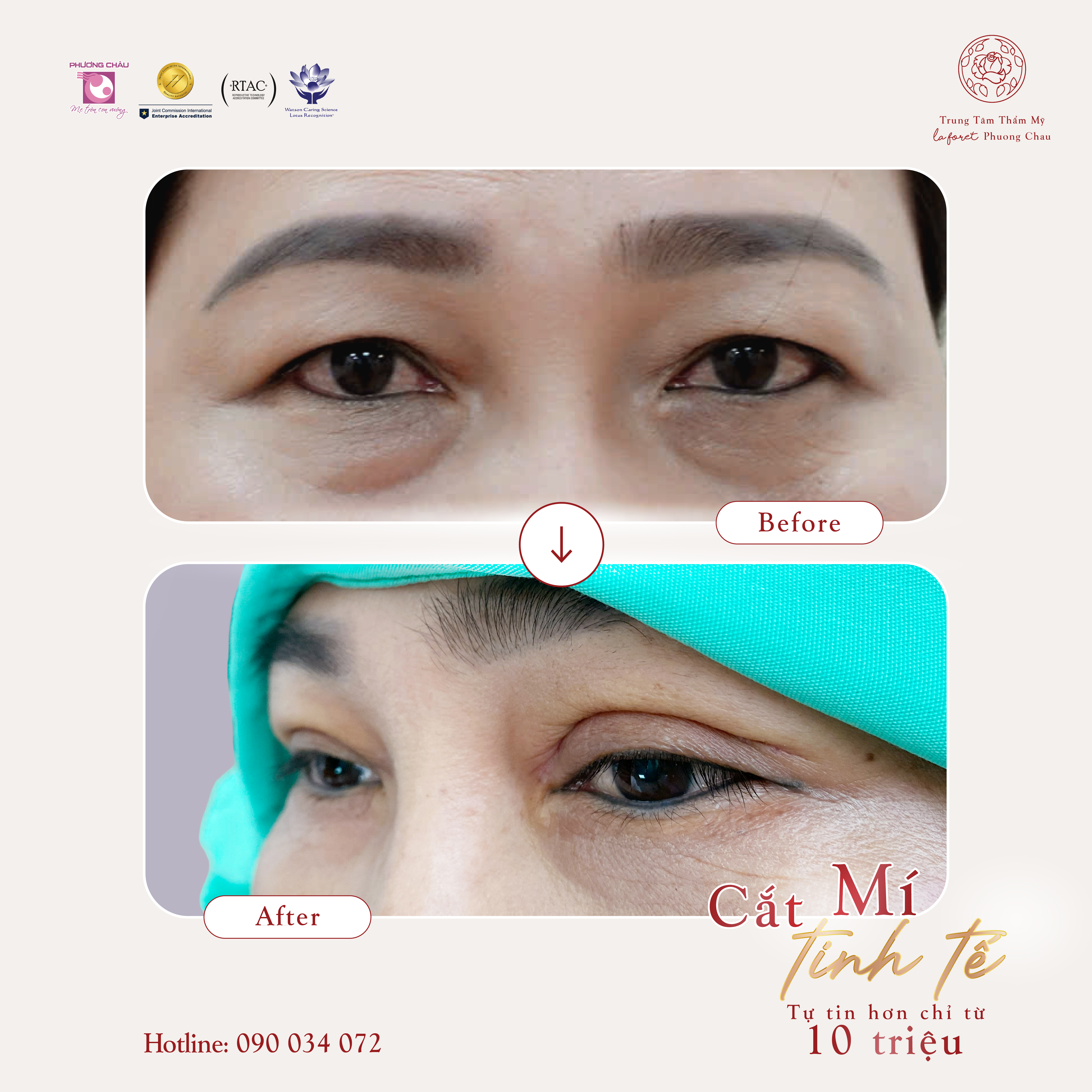 Cắt Mí Tinh Tế – Tự Tin Hơn Chỉ Từ 10 Triệu