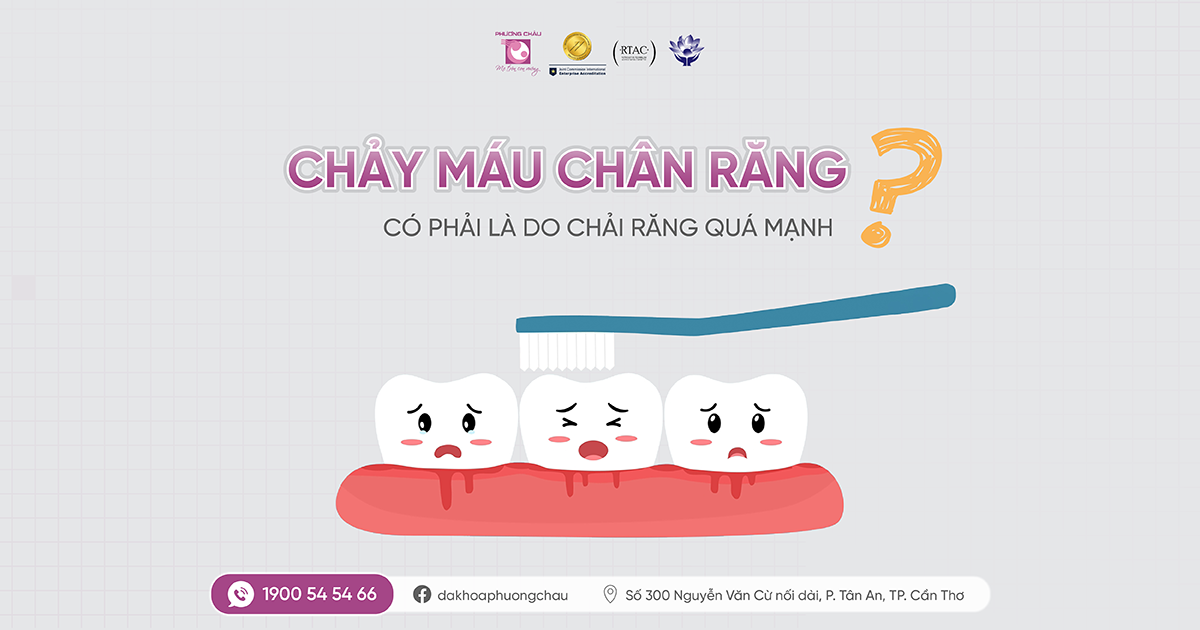 Chảy máu chân răng là do chải mạnh hay dấu hiệu bệnh lý răng miệng?