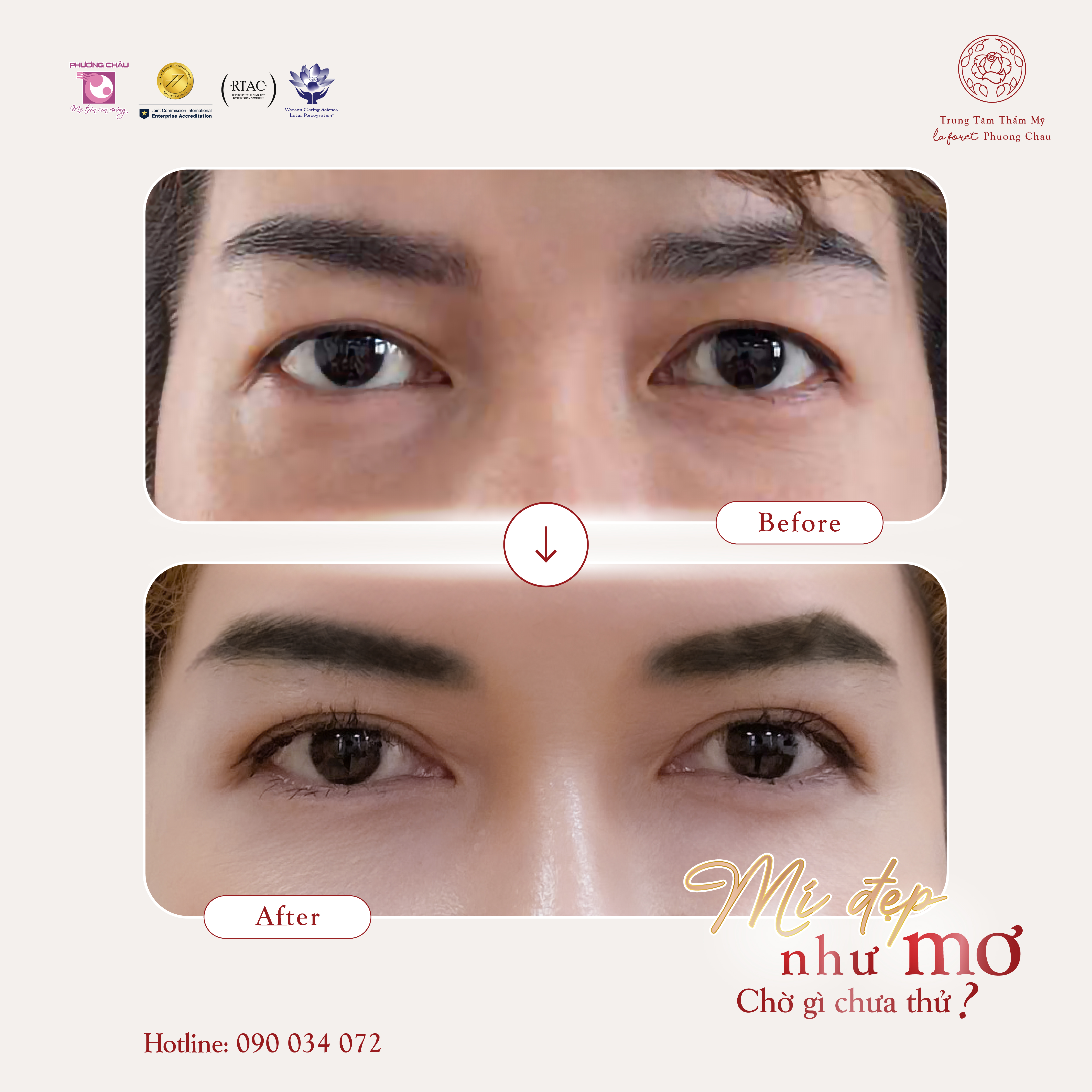 Mí Đẹp Như Mơ - Chờ Gì Chưa Thử