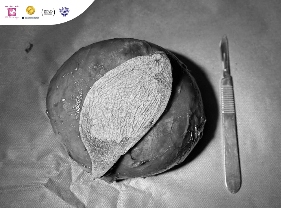 Bóc khối bướu lớn vùng mông: Hành trình vượt qua nỗi lo và tìm lại sự an tâm