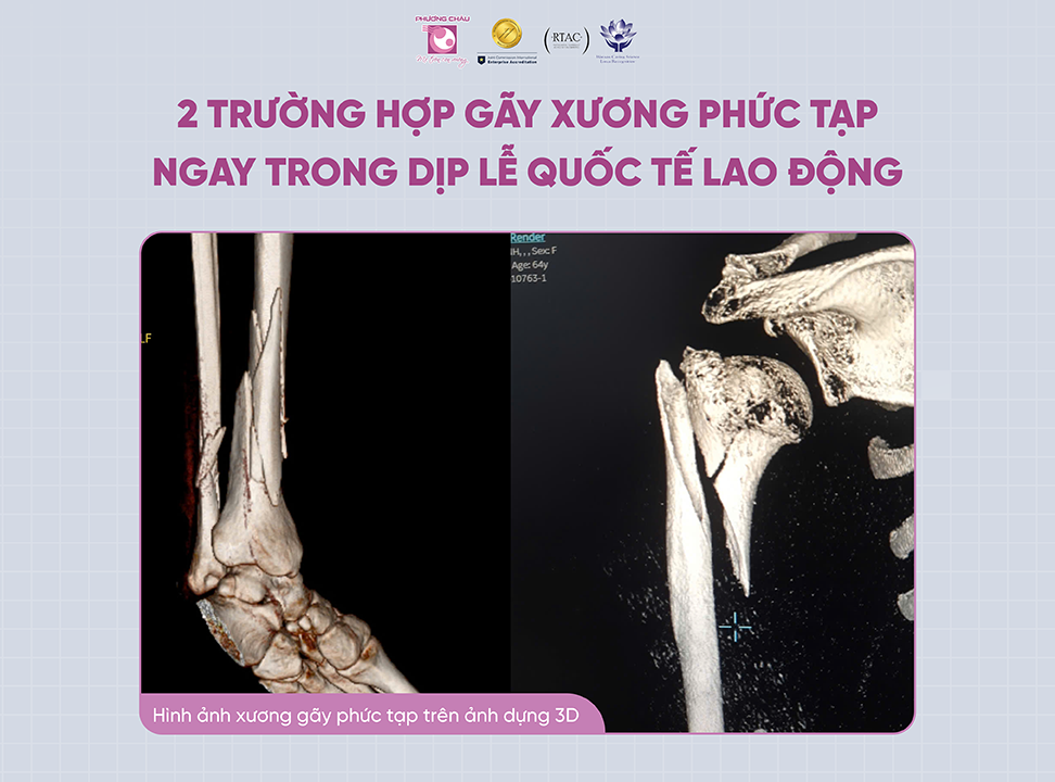 Phẫu thuật thành công hai ca gãy xương phức tạp ngay trong dịp Lễ Quốc tế Lao động