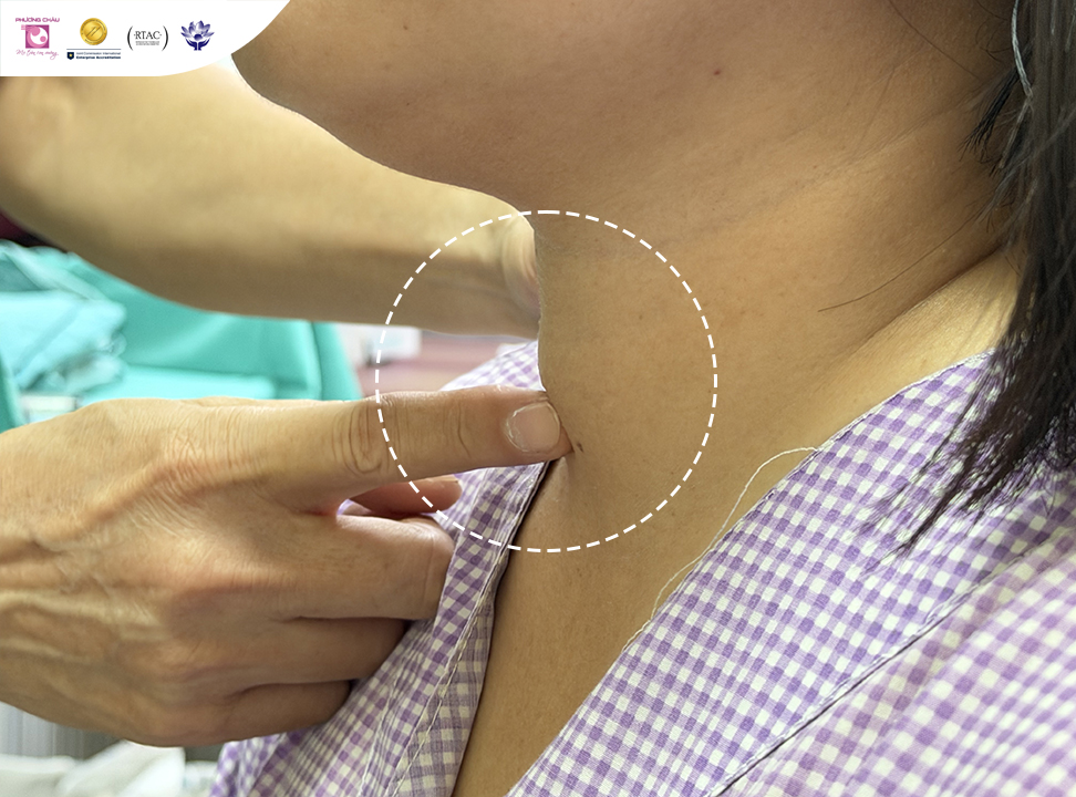 Tự tin hơn, an tâm hơn với phương pháp đốt sóng cao tần điều trị bướu giáp nhân