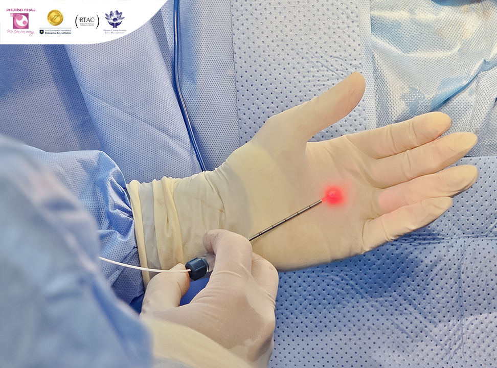 Phẫu thuật trĩ bằng laser: Ít xâm lấn, không đau và hồi phục nhẹ nhàng hơn