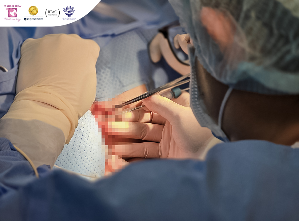 Phẫu thuật trĩ laser giúp người bệnh nhẹ lòng sau nhiều năm âm thầm chịu đựng nỗi niềm khó nói