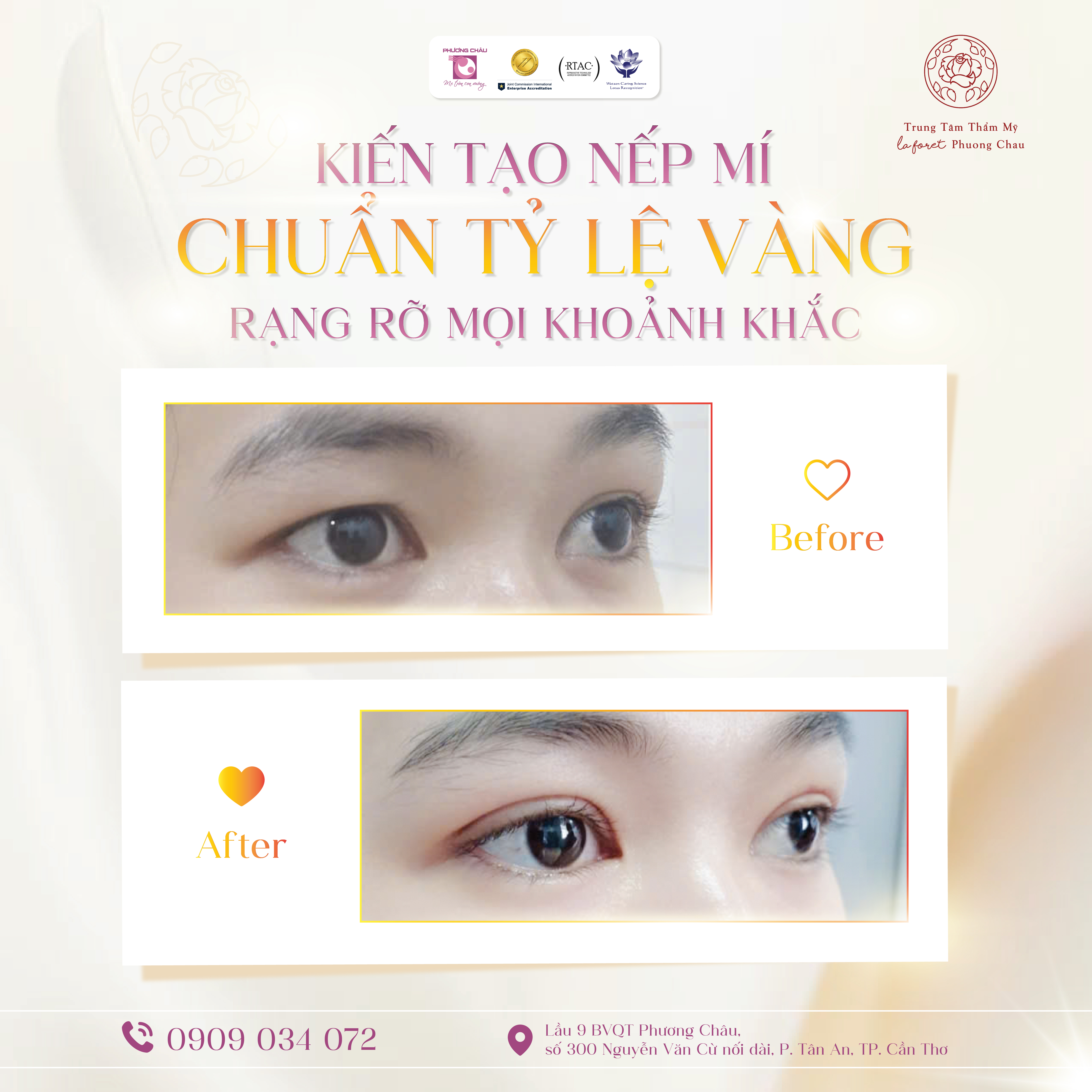 Kiến tạo nếp mí "chuẩn tỷ lệ vàng", rạng rỡ mọi khoảnh khắc