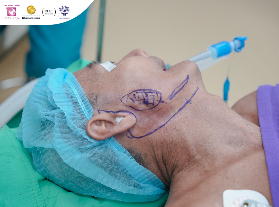 Phẫu thuật cắt trọn thuỳ nông tuyến mang tai, bảo tồn chức năng dây thần kinh mặt cho người bệnh 76 tuổi