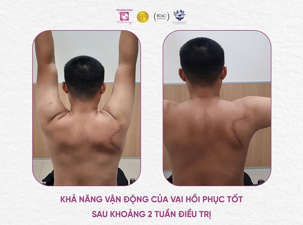 Phẫu thuật kết hợp xương kịp thời cho chàng trai 26 tuổi gãy xương vai di lệch nặng sau tai nạn