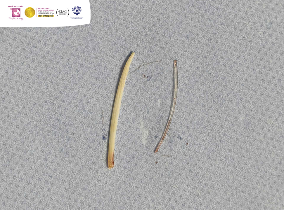 Đau bụng kéo dài, đi khám phát hiện 2 chiếc xương “đi lạc” bên trong ổ bụng