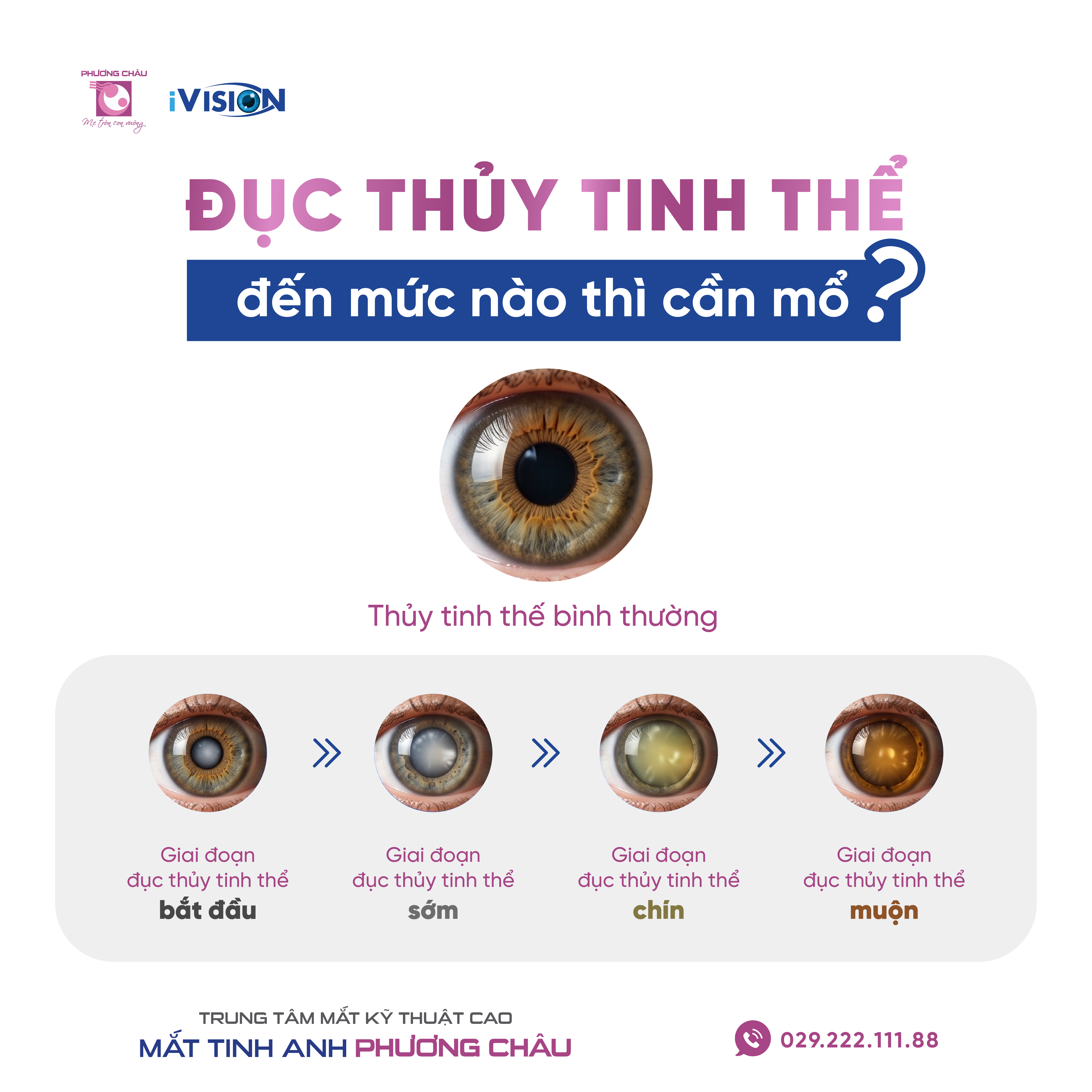 Đục Thủy Tinh Thể Đến Mức Nào Thì Cần Mổ?