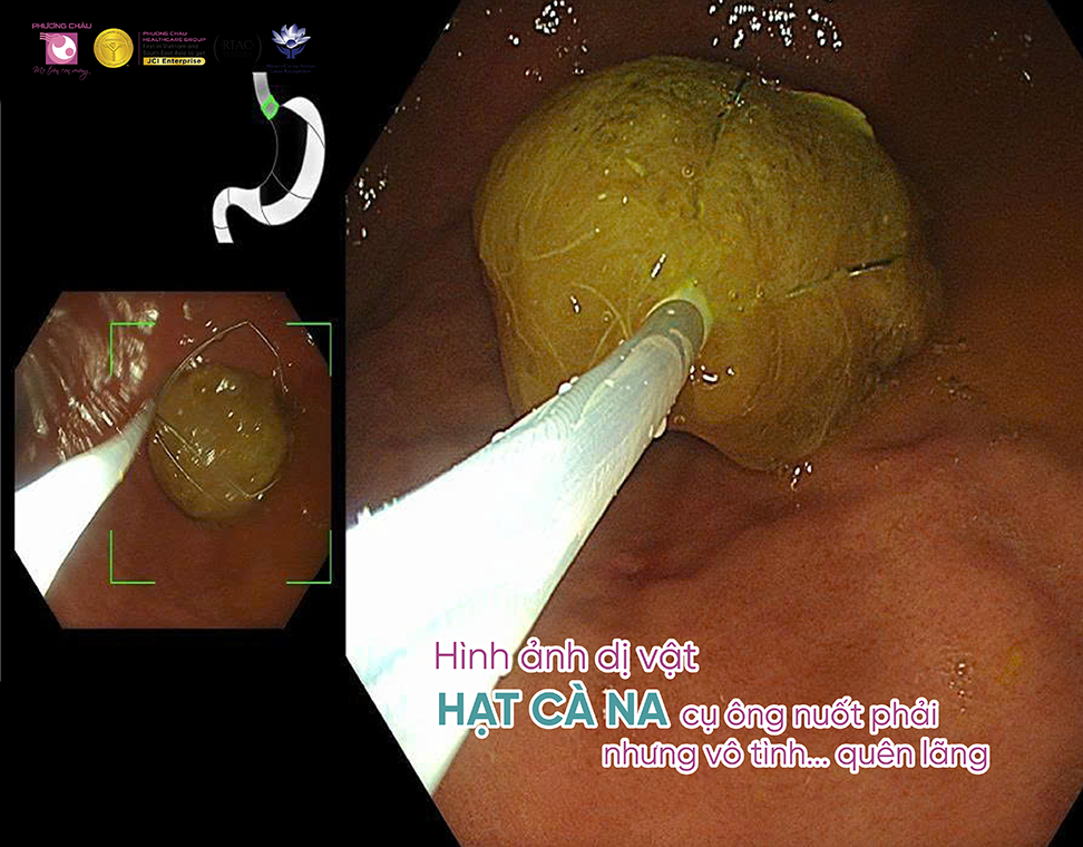 Nhiều trường hợp dị vật đường tiêu hóa được phát hiện và xử trí thành công tại Phương Châu