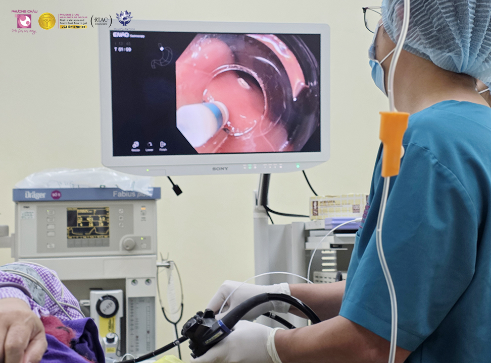 Nội soi định kỳ bất ngờ phát hiện khối u lớn 15mm dù không đau, không triệu chứng