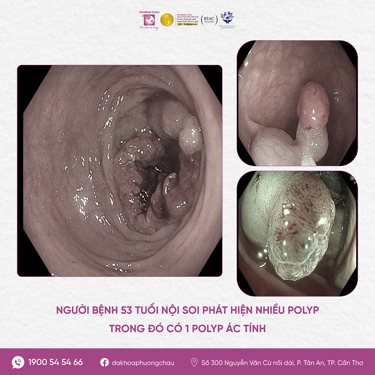 Nhiều trường hợp phát hiện tổn thương nguy hiểm ở đường tiêu hóa nhờ chủ động nội soi tầm soát định kỳ