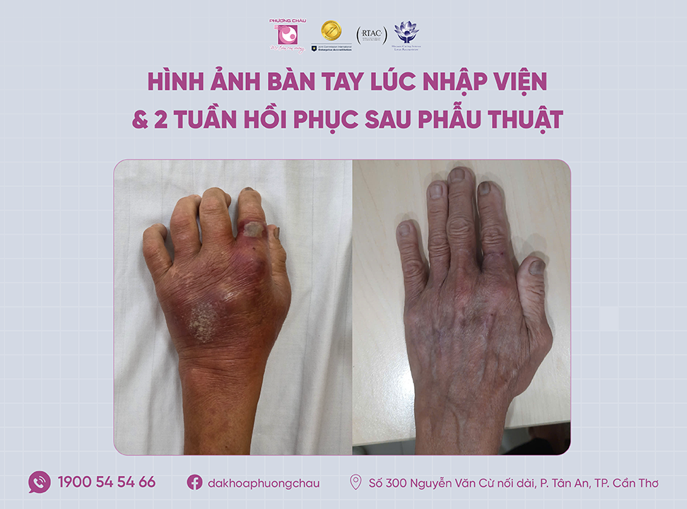 Hình ảnh ban tay bị côn trùng cắn và khoảng 2 tuần hồi phục sau phẫu thuật