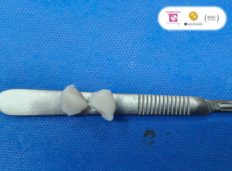 chán thương khớp gối