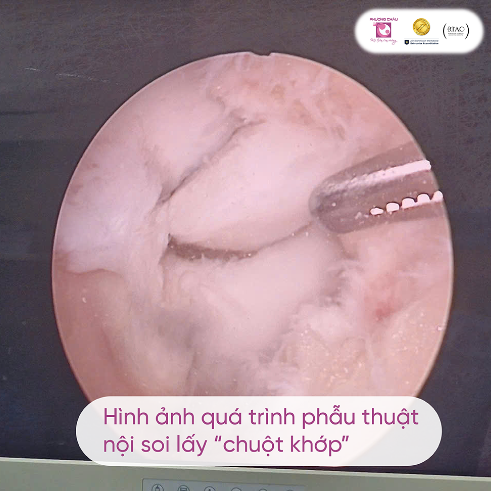 chấn thương khớp gối