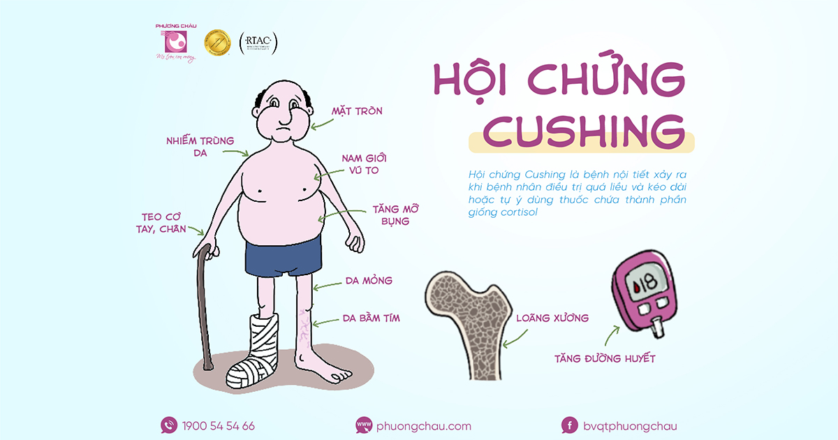 Hội chứng Cushing có thể gây nhiều biến chứng nguy hiểm