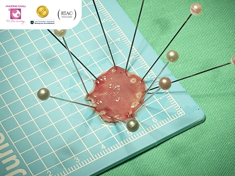 khâu diện cắt sau esd qua nội soi