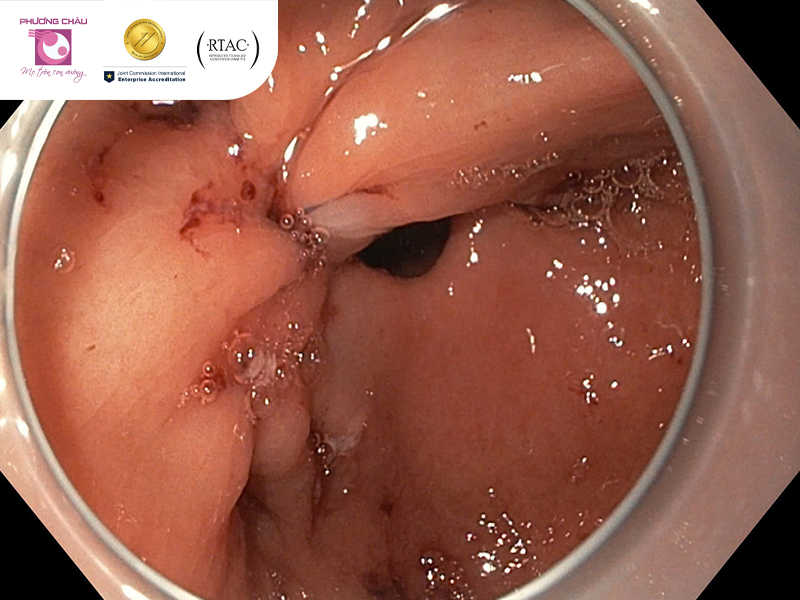 khâu diện cắt sau esd qua nội soi