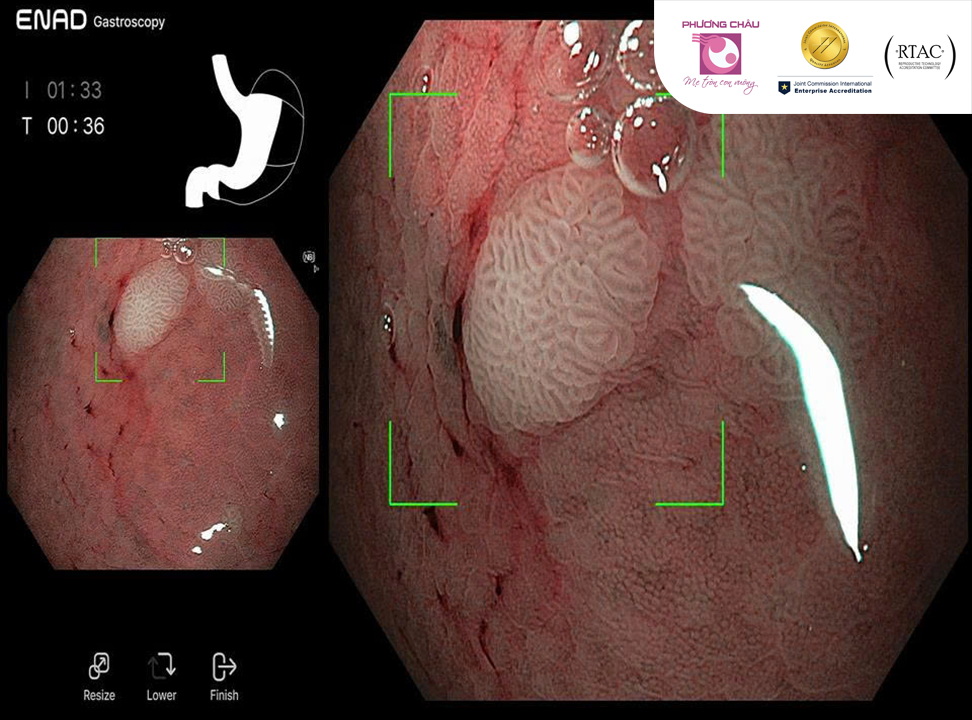 Hình ảnh polyp phát hiện qua nội soi trí tuệ nhân tạo