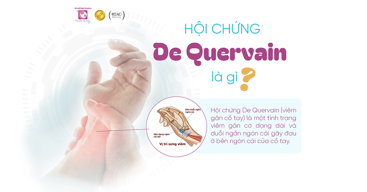 Viêm bao gân cổ tay là một hội chứng rất thường gặp ở nhân viên văn phòng và người hoạt động cổ tay nhiều