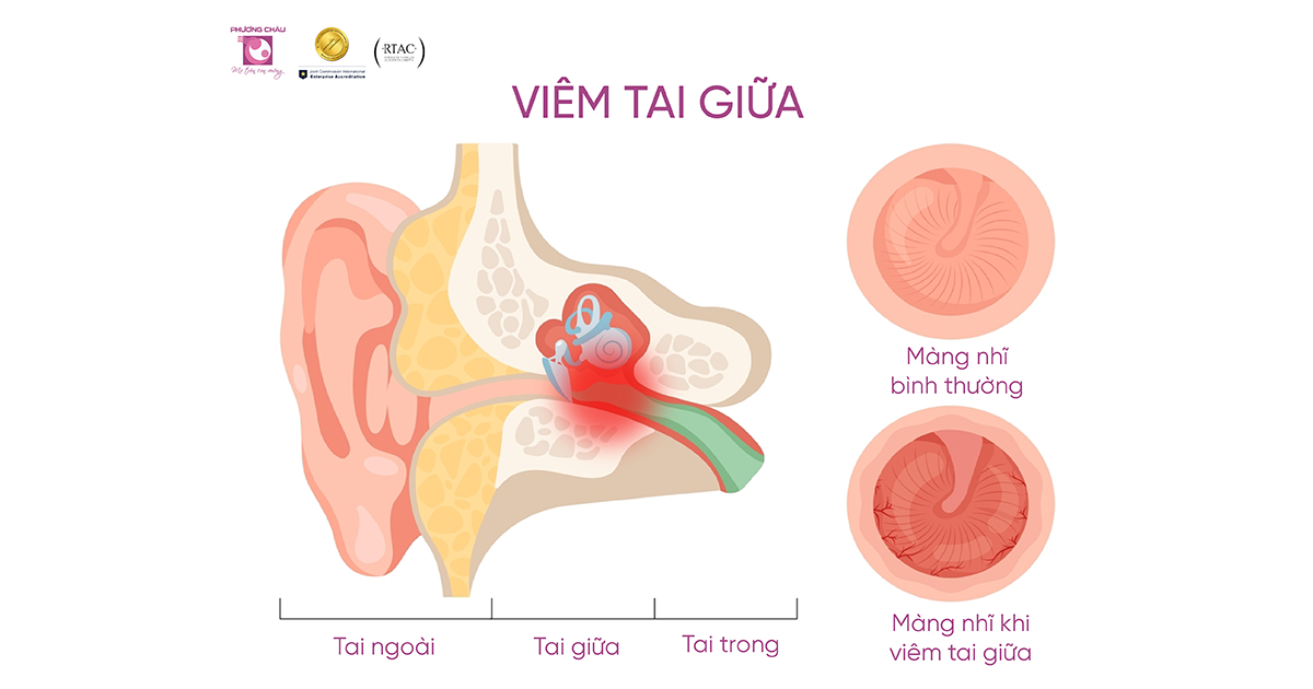 Viêm tai giữa là bệnh lý phổ biến thường gặp ở mọi lứa tuổi, nhưng thường gặp ở trẻ em