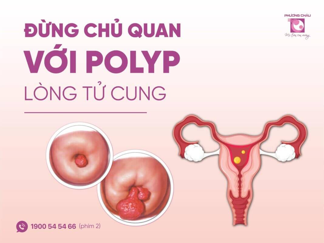 Đừng Chủ Quan Với Polyp Lòng Tử Cung