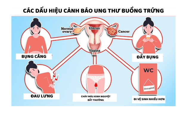 Ung thư buồng trứng và các yếu tố nguy cơ - Phương Châu Group