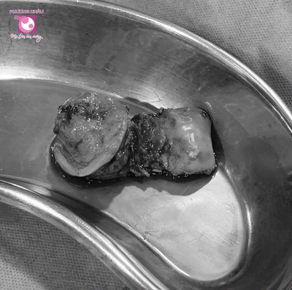 SA SINH DỤC – “CĂN BỆNH KHÓ NÓI” CỦA PHỤ NỮ TRUNG NIÊN VÀ CAO TUỔI
