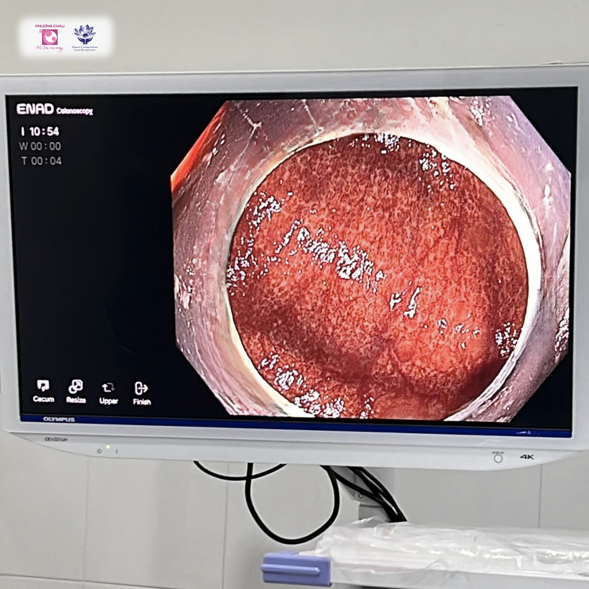 MỘT CHIẾC ĐẠI TRÀNG "ĐỔI MÀU" SAU NHIỀU NĂM LẠM DỤNG THUỐC NHUẬN TRÀNG