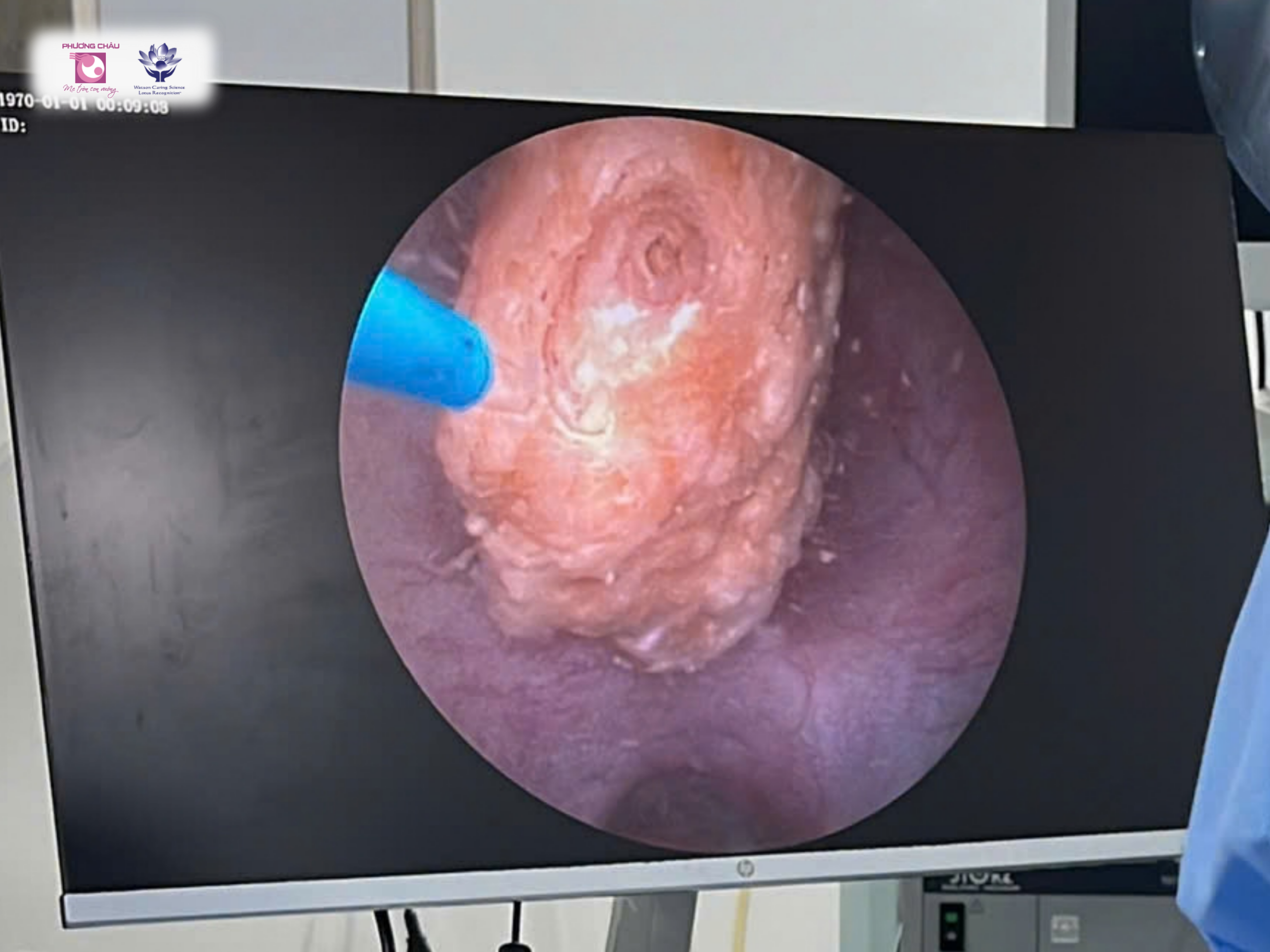 Đau dữ dội vùng hông trái, phát hiện sỏi niệu quản 15 mm