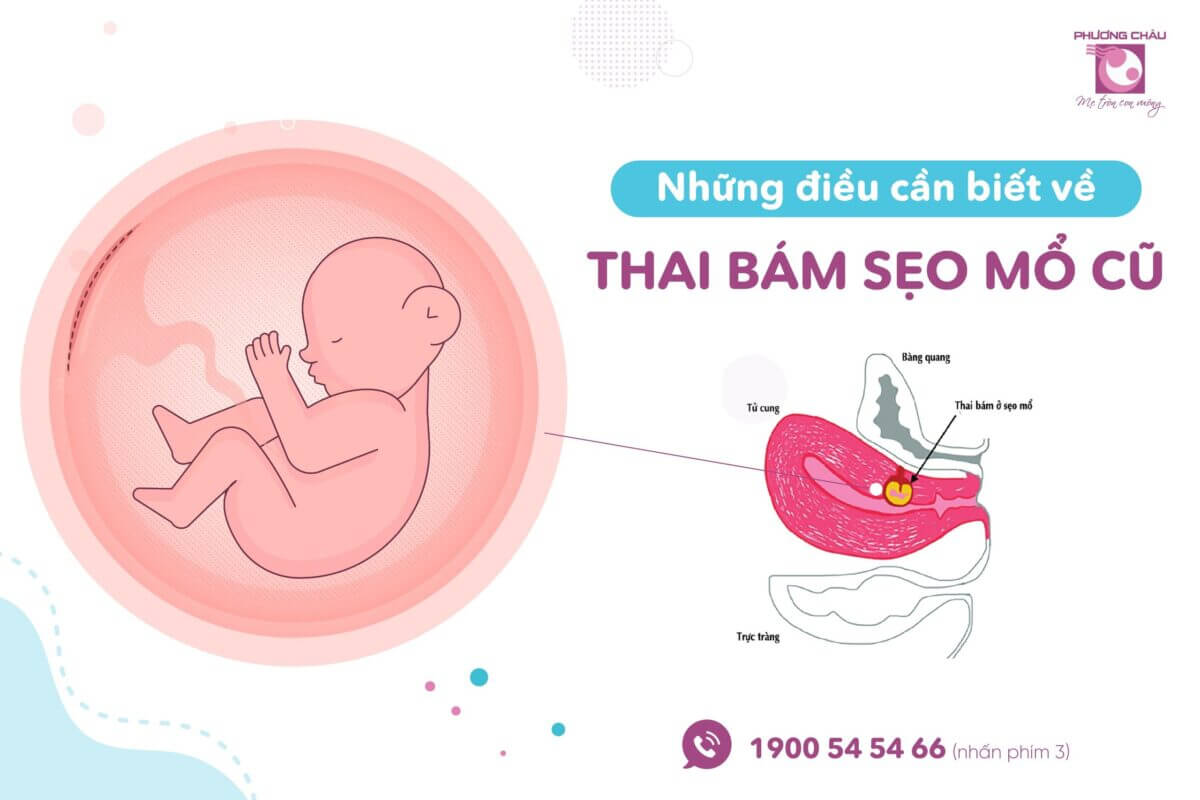 Những Điều Cần Biết Về Thai Bám Sẹo Mổ Cũ