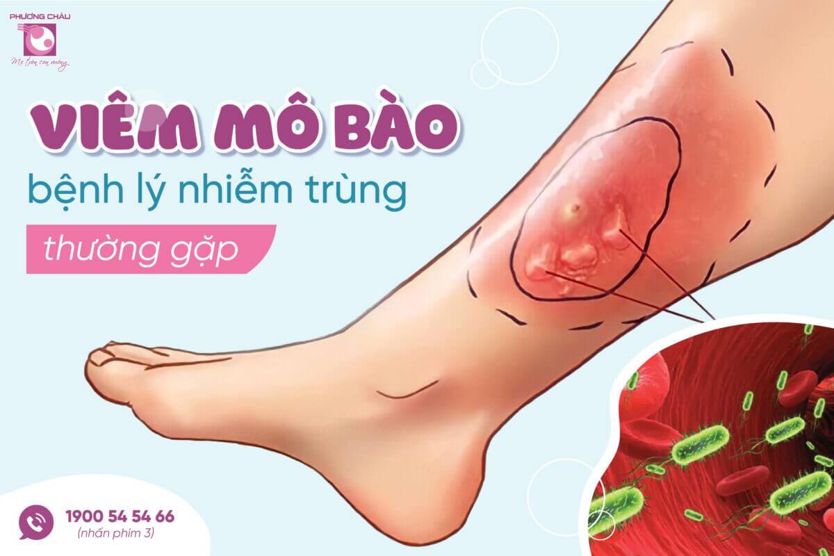 Viêm mô bào: nguyên nhân, triệu chứng và cách điều trị